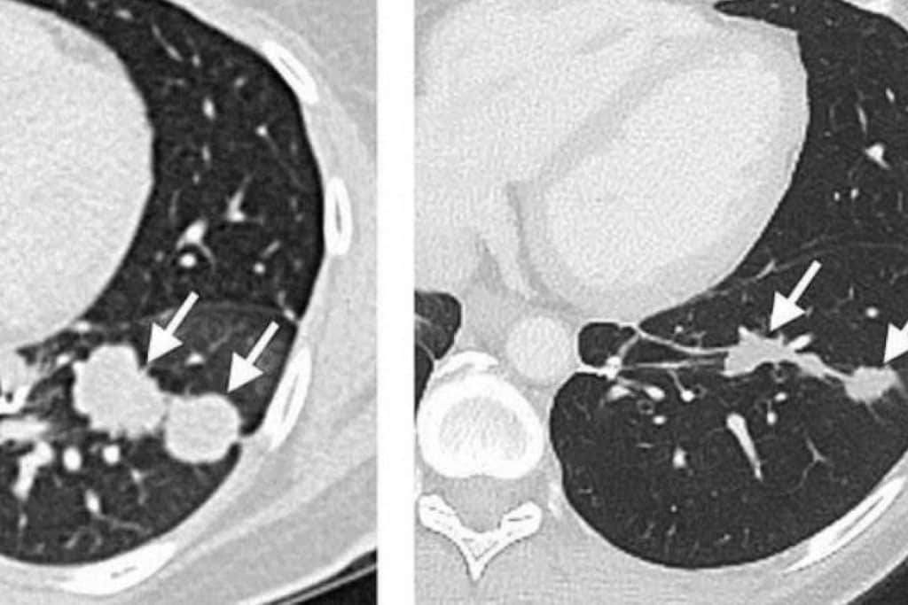 Oncovix; Inmunoterapia de Precisión, un Hito en la Revolución del Tratamiento del Cáncer