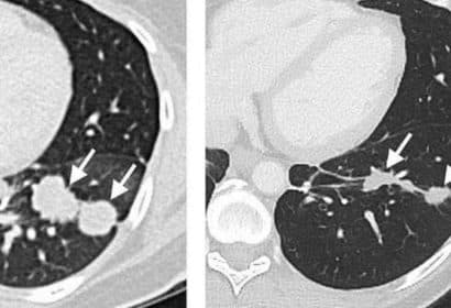 Oncovix; Inmunoterapia de Precisión, un Hito en la Revolución del Tratamiento del Cáncer
