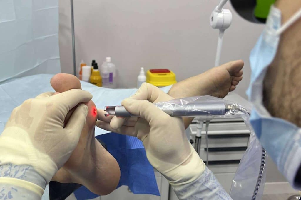 DM Clínica innova en podología con su tratamiento láser para cirugías de uñas y papilomas