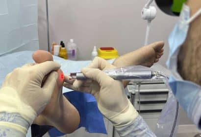 DM Clínica innova en podología con su tratamiento láser para cirugías de uñas y papilomas