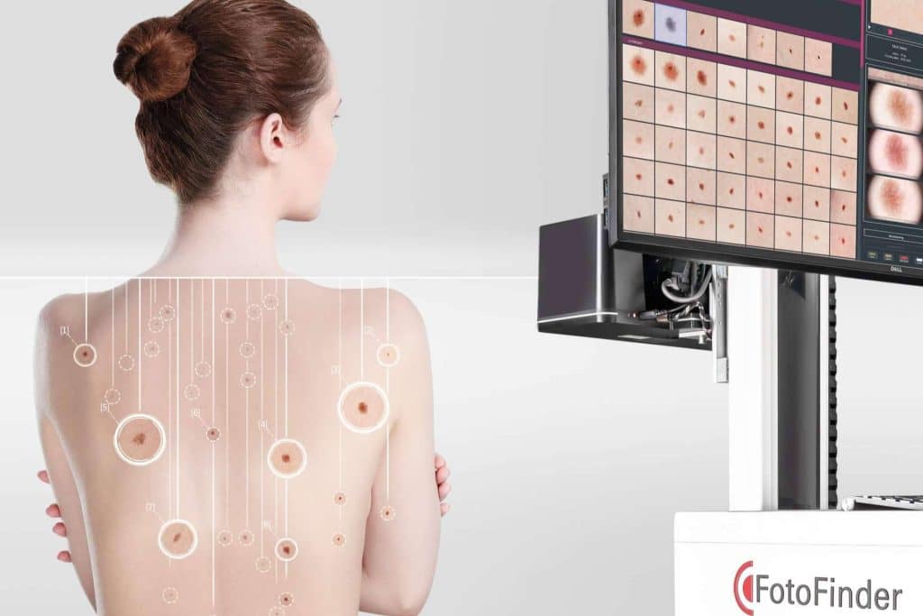FotoFinder optimiza el diagnóstico para la prevención y detección temprana del cáncer de piel