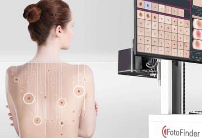 FotoFinder optimiza el diagnóstico para la prevención y detección temprana del cáncer de piel