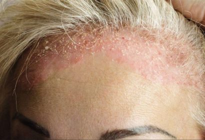 Qué es la foliculitis; causas, factores y prevención para el invierno