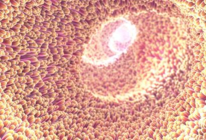 Colon irritable; Un diagnóstico impreciso que en muchos casos oculta trastornos reversibles y tratables